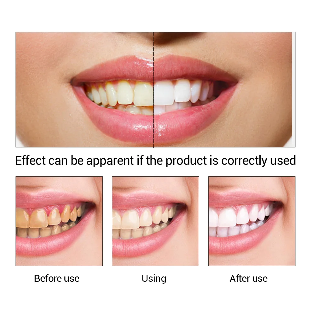 FTEENPLY Zahnaufhellung Essenz – Teeth Whitening Singapore Bewertung und Preis