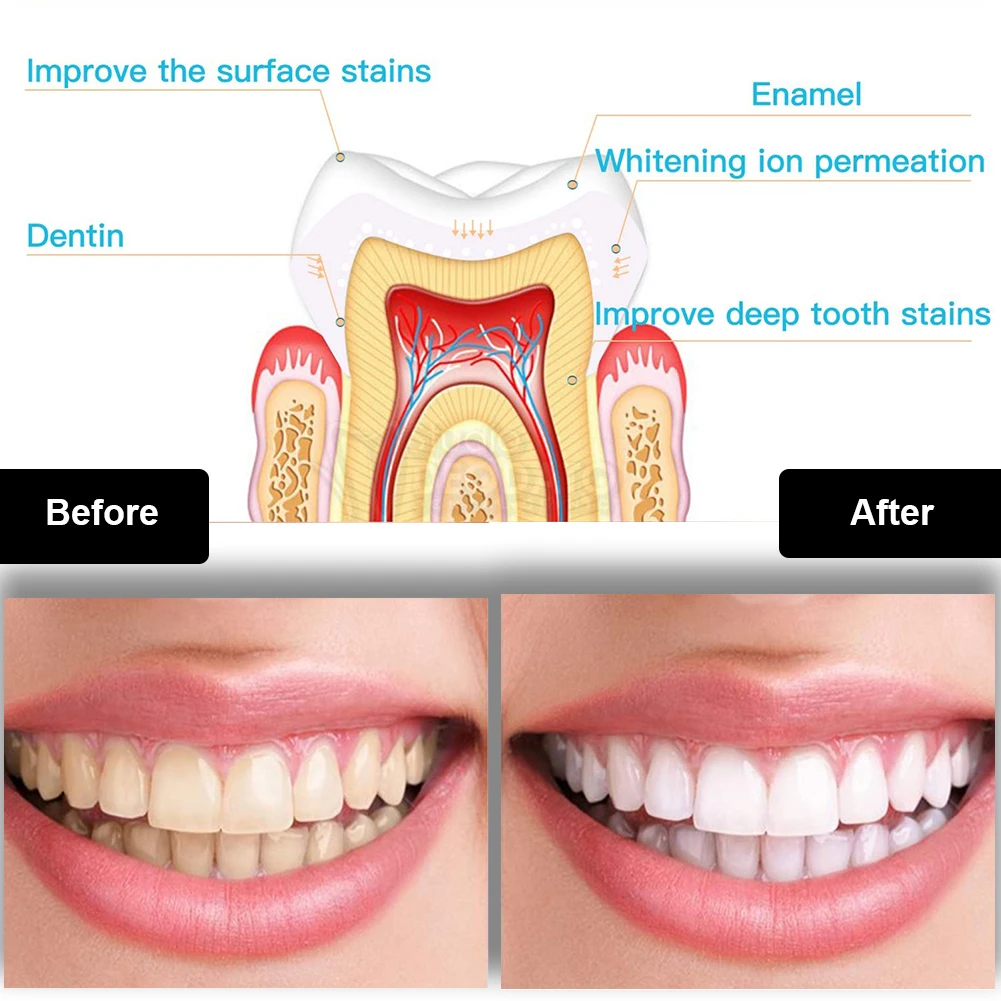 Dental Zahnaufhellung Kit Mini – Teeth Whitening Singapore Bewertung und Preis